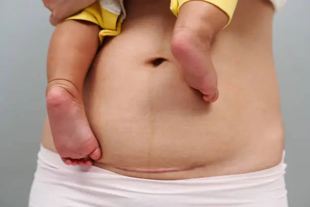 breasfeeding position for c-section